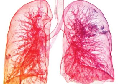 Lung Cancer Spread | Alegent Creighton